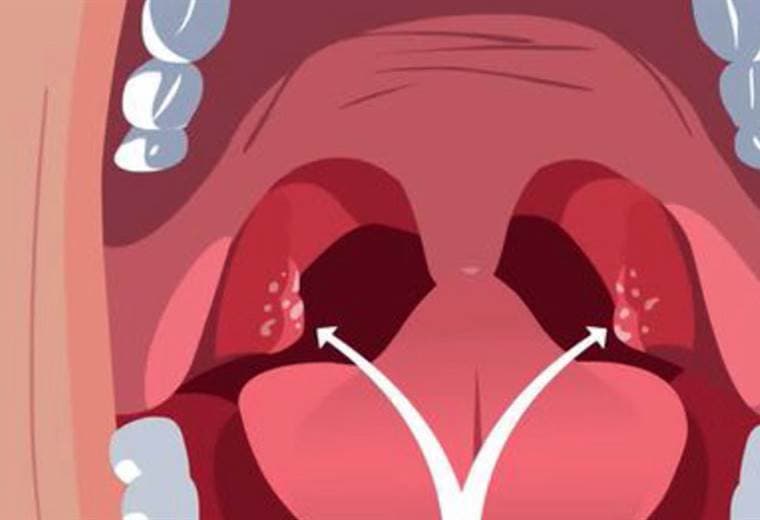 Conozca más sobre el Caseúm o masas en la garganta