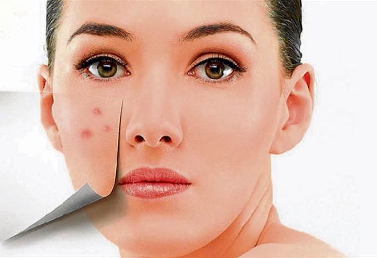 Acné por estrés y sus consecuencias