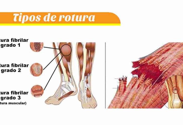 Desgarros musculares: Prevención y tratamientos