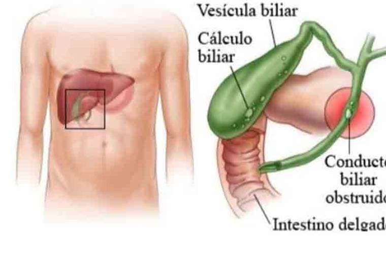 ¿Por qué se forman las piedras en la vesícula?
