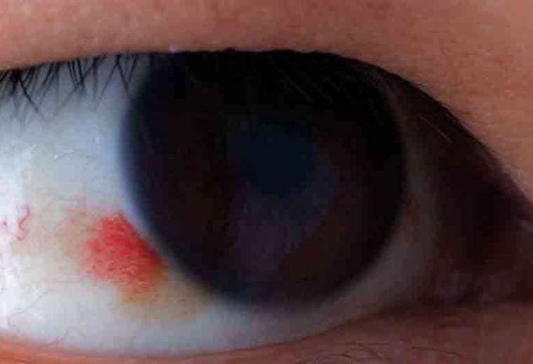 Causas de las manchas blancas, rojas y negras de los ojos 