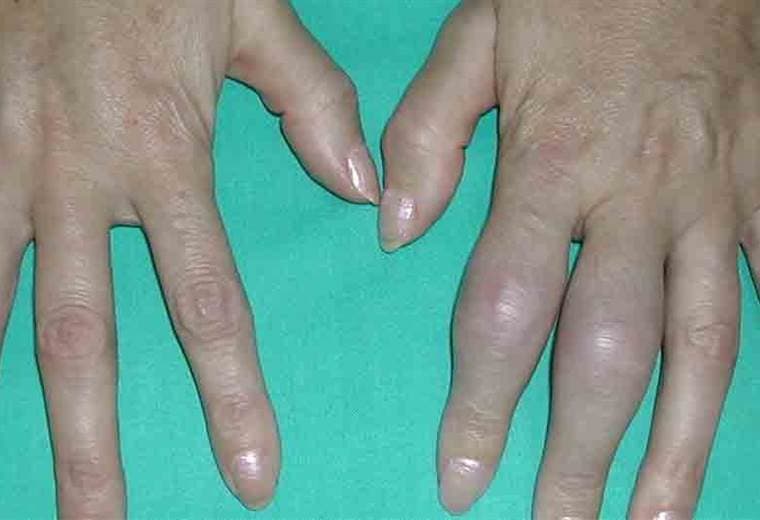 Conozca los tratamientos para combatir la pseudogota