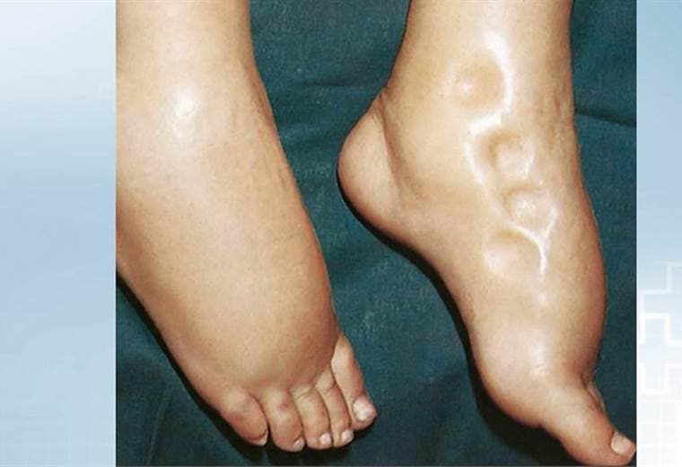 ¿Qué tan común es la retención de líquido en piernas?