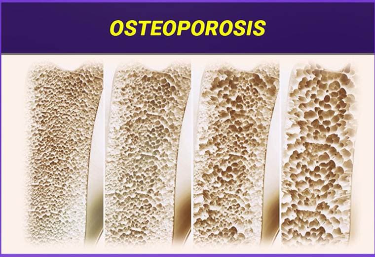¿Qué es la osteoporosis?
