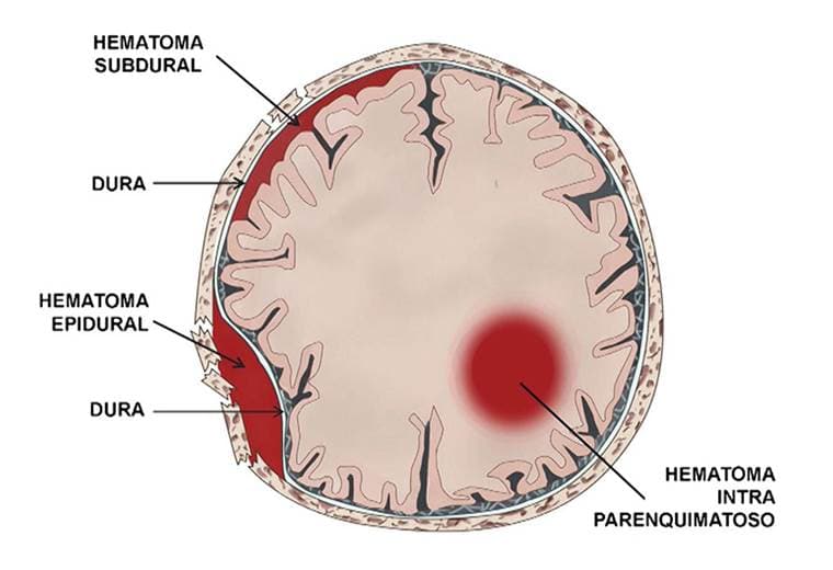Causas y consecuencias de los coágulos de sangre en el adulto mayor