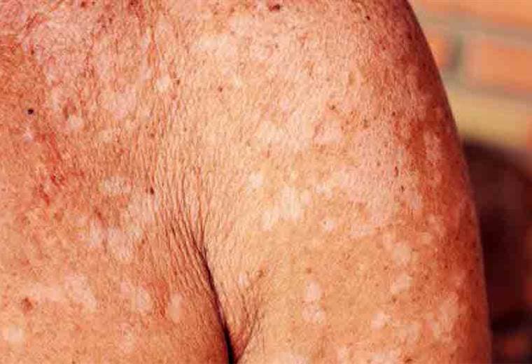 Aprenda a quitar correctamente un hongo de su piel