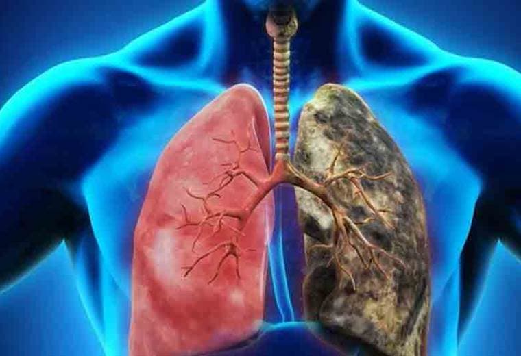 ¿Qué es un efisema pulmonar y cuáles son los factores de riesgo para padecer la enfermedad?