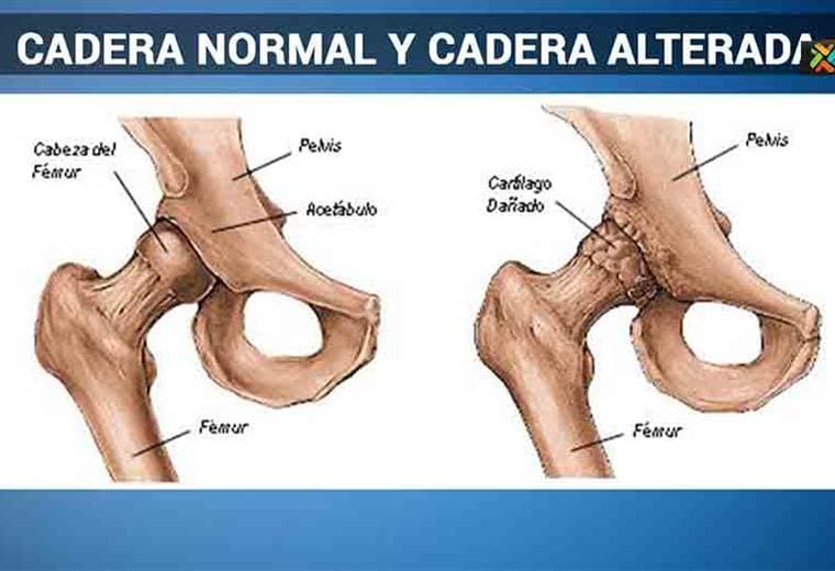 Hablamos sobre desgaste de caderas