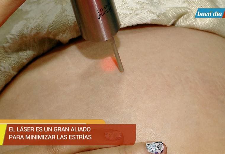 El láser es un gran aliado para minimizar las estrías