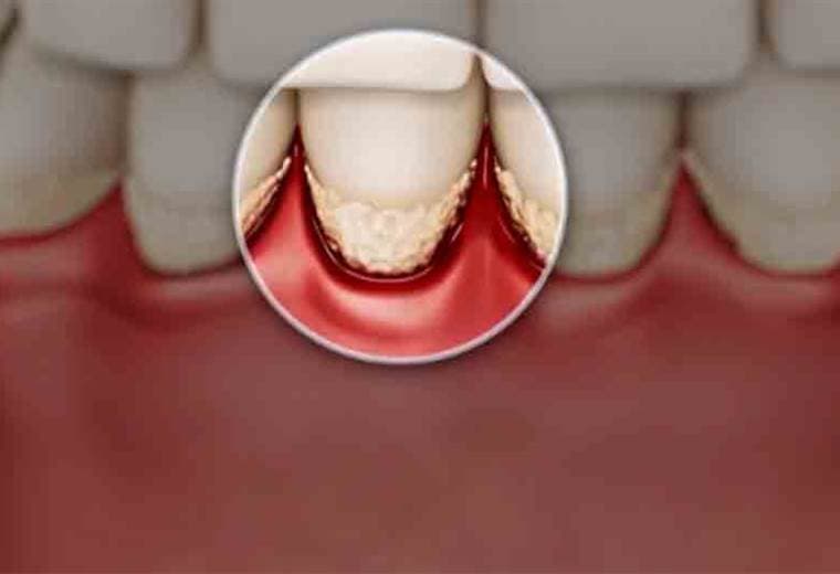 Conozca las causas más comunes de la gingivitis y cuáles son sus consecuencias