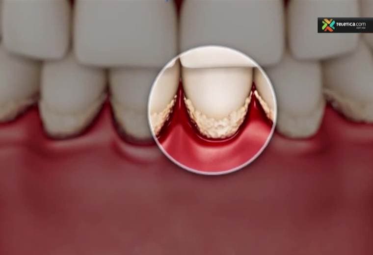 Conozca las causas más comunes de la gingivitis y cuáles son sus consecuencias