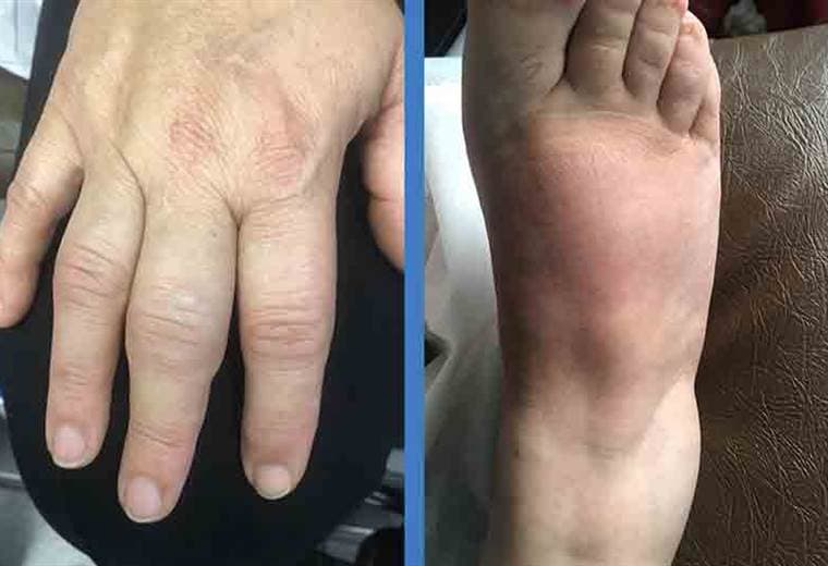 ¿En qué consiste enfermedad de raynaud?