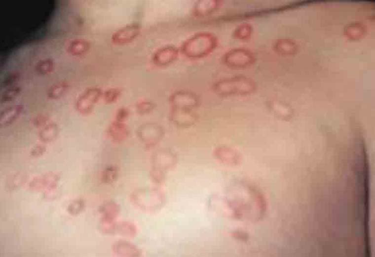 ¿Se puede prevenir la aparición de hongos en la piel?