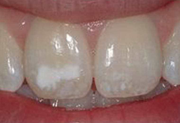 ¿Qué pasa cuando perdemos el esmalte de los dientes?