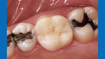 ¿Qué provocan las calzas desajustadas?