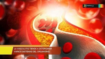 Hablamos sobre vasculitis, una enfermedad reumática
