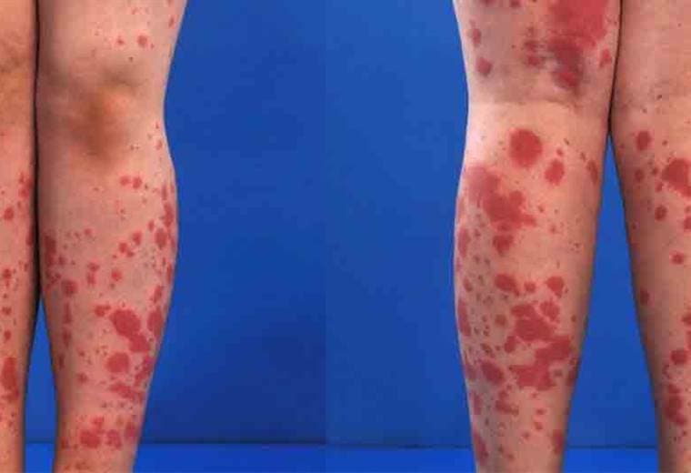 Hablamos sobre vasculitis, una enfermedad reumática 