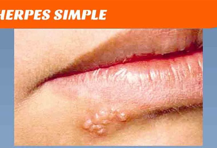 Hablamos sobre herpes zóster y herpes simple
