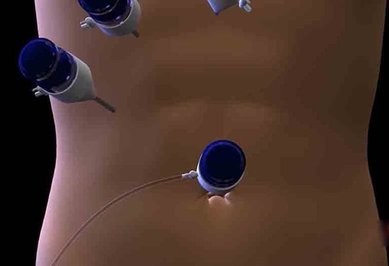 ¿Por qué se forman piedras en la vesícula?