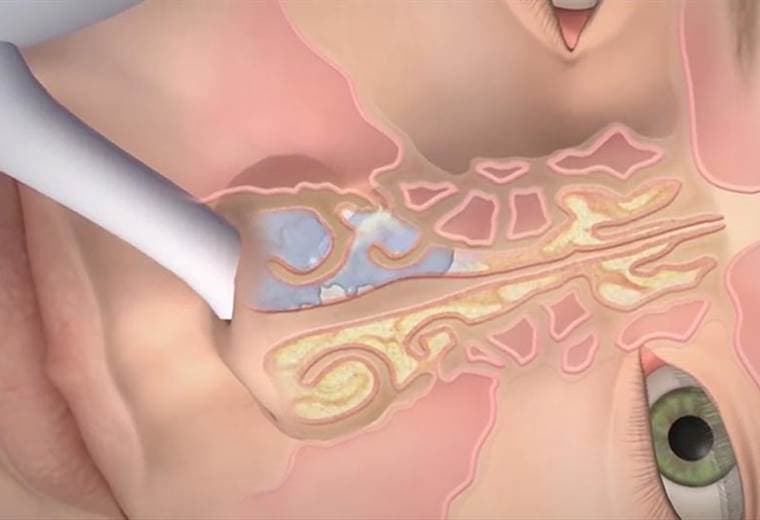 Beneficios del lavado nasal