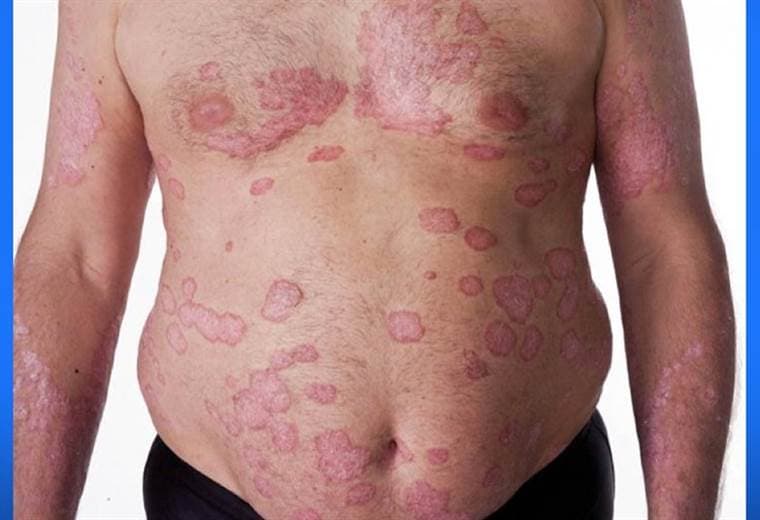 Lesiones en piel por estrés