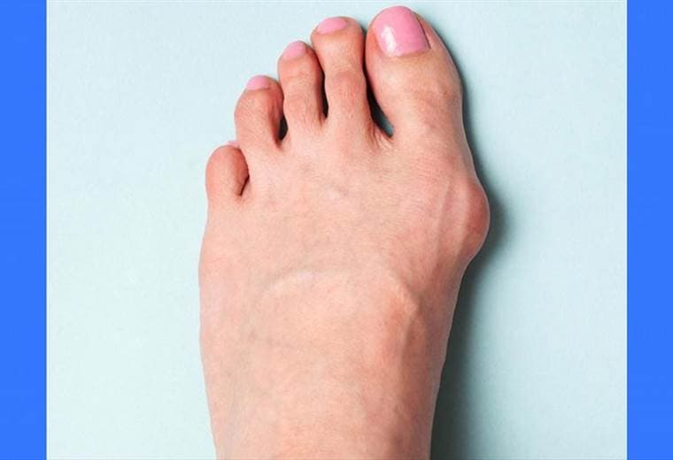 Aprenda cómo y por qué se forman los juanetes