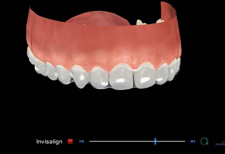 Ortodoncia invisible