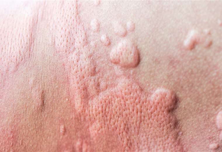 Salud confirma cuarto caso de sarampión: un cartaginés con viaje reciente a Guatemala