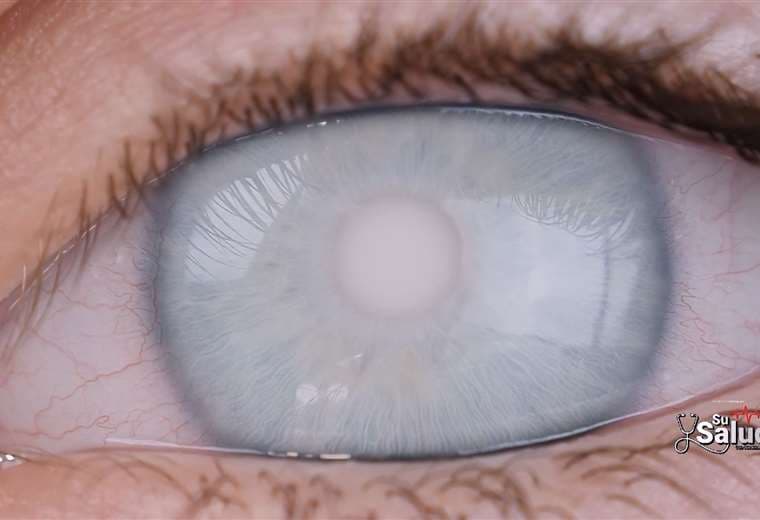 Cataratas: cinco preguntas básicas para entender este diagnóstico