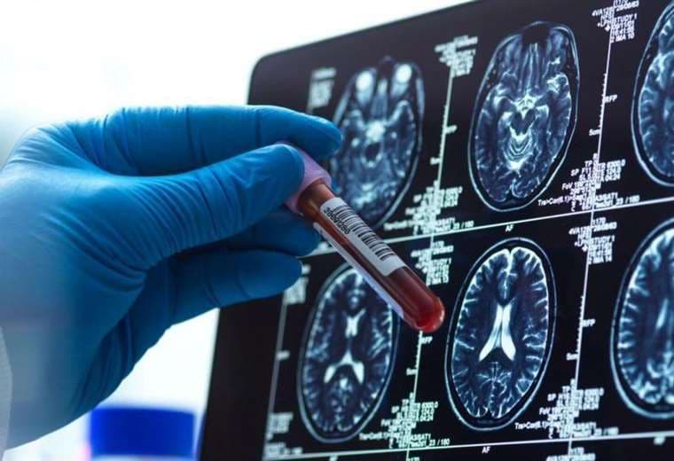 Cuatro avances esperanzadores para la enfermedad de Alzheimer este año