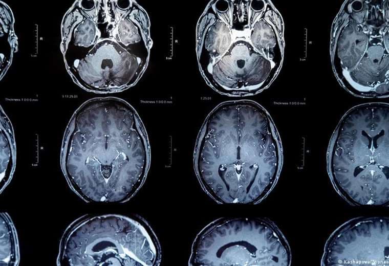 Tumores cerebrales: nueva vacuna ofrece esperanza de vida