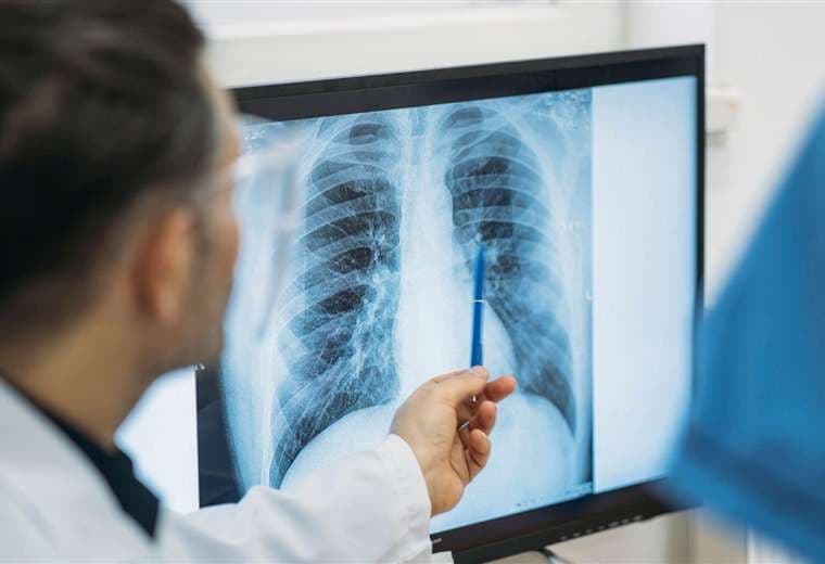 ¿Qué es un adenocarcinoma pulmonar? tipo de tumor maligno extirpado al papa León XIV