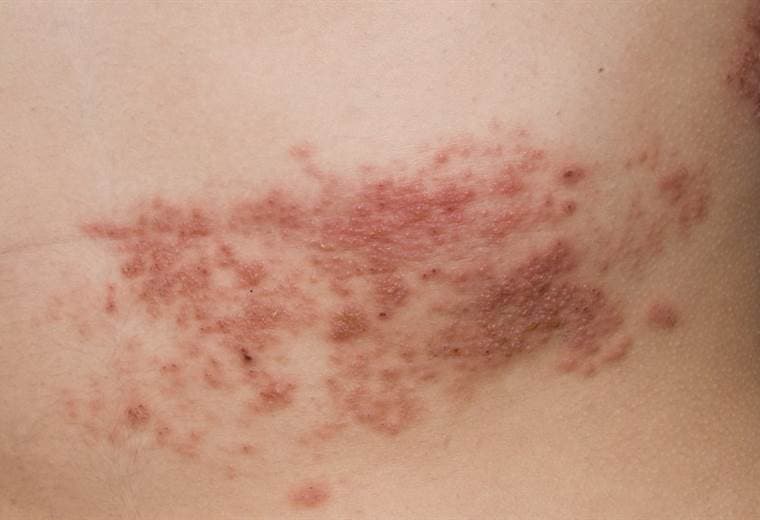 Herpes zóster, la otra enfermedad que el virus de la varicela te puede causar 