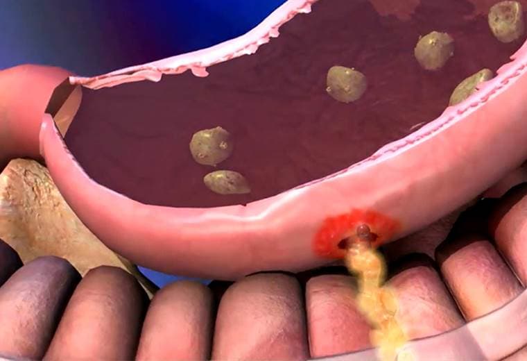 ¿Por qué se hacen las úlceras gástricas y cómo saber cuando sangran?