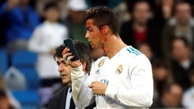 Cristiano Ronaldo sufrió una herida en su rostro en el juego contra el Deportivo. 