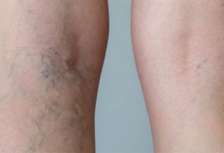 ¿Cómo distinguir que las manchas en las piernas son originadas por várices?