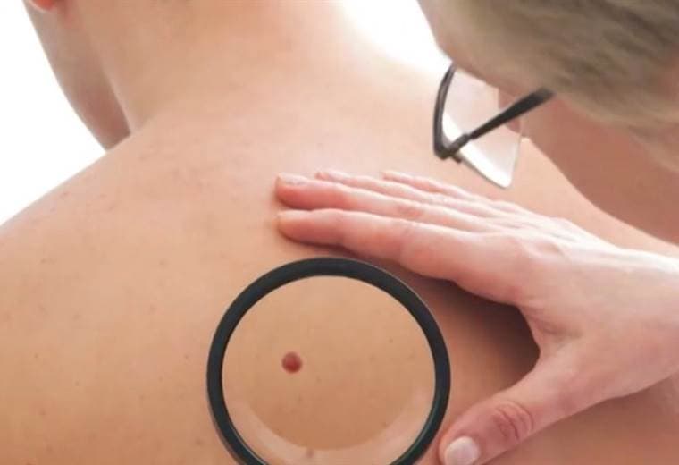 ¿Quiénes son más propensos a sufrir cáncer de piel?