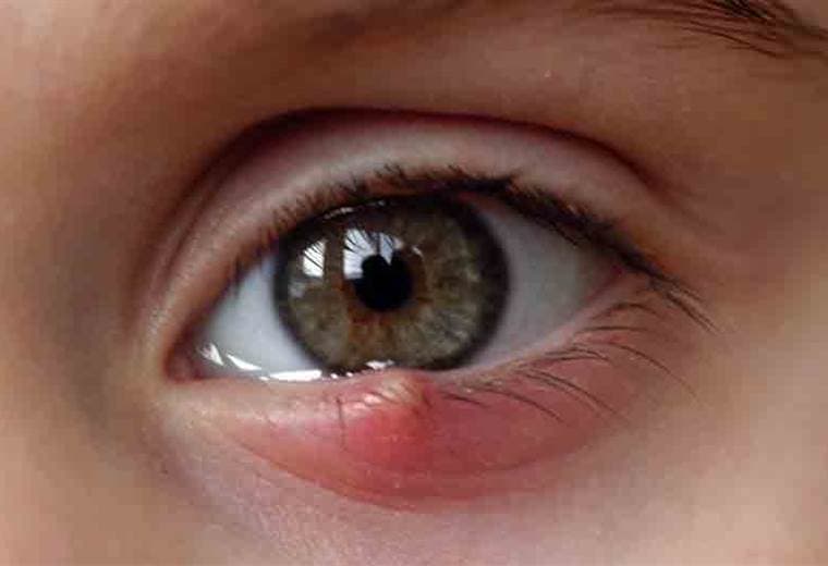 Consejos para evitar tener orzuelos