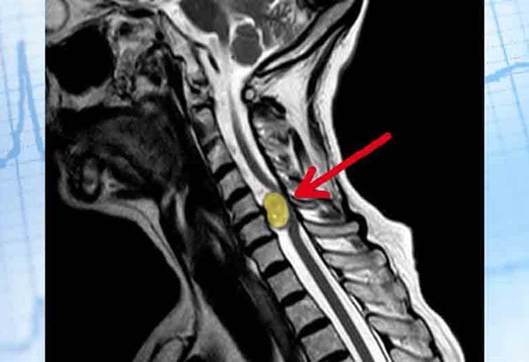 ¿Qué es un tumor espinal?