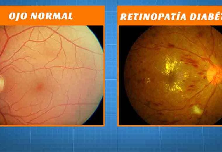 Hablamos acerca de la retinopatía diabética