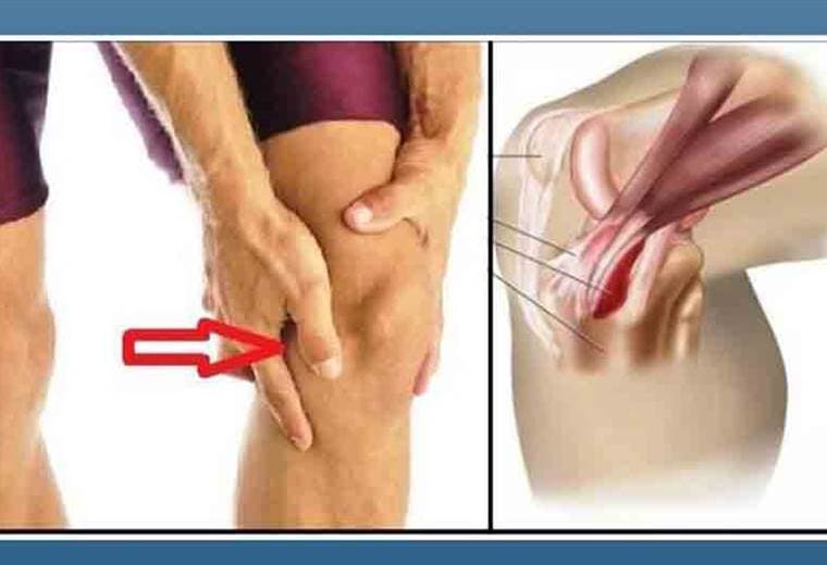 ¿Qué es la tendinitis de rodilla?