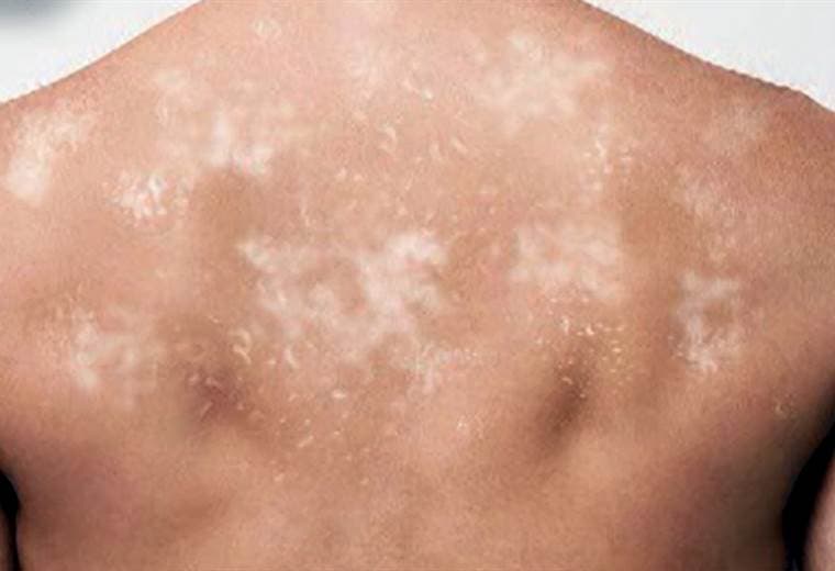Hablamos sobre las manchas en la piel provocadas por el verano
