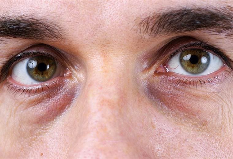 Aprenda a detectar la uveítis de sus ojos