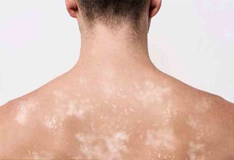 Consejos para eliminar los hongos de la piel que parecen manchas