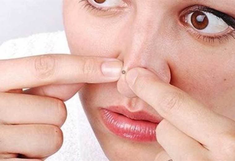 ¿Cuáles son las causas más comunes de puntos negros en la cara?