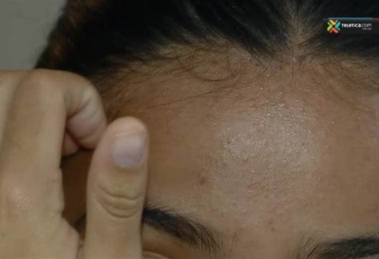 ¿Cuáles son las causas más comunes de puntos negros en la cara?