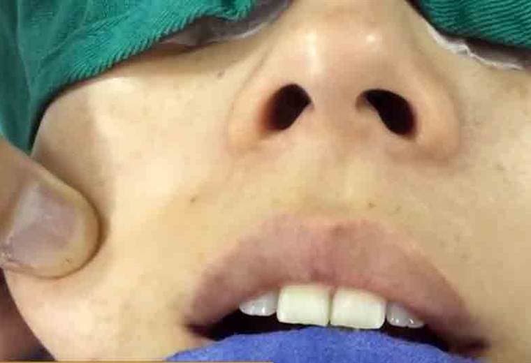 Conozca el método milagroso para eliminar los cachetes