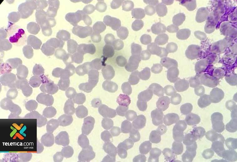 Examen de sangre conocido como 'La gota gruesa' permite diagnosticar la malaria