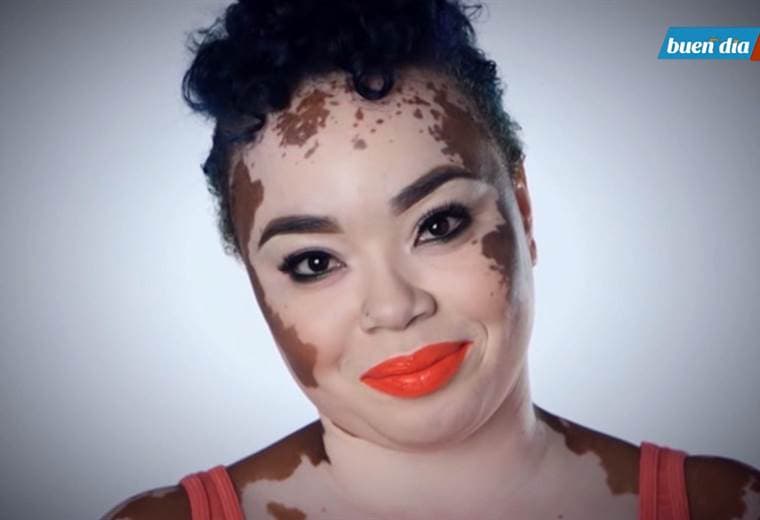 Tratamientos para mejorar las manchas por vitiligo