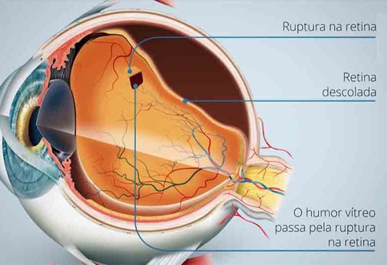 Hablamos sobre el desprendimiento de retina y sus síntomas